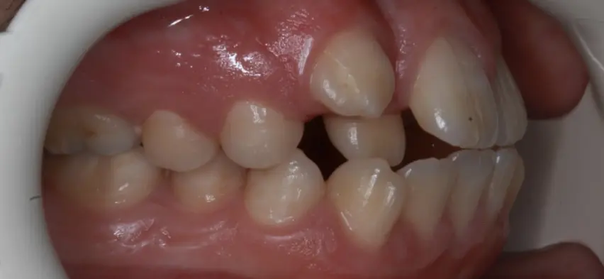 Antes de la Ortodoncia