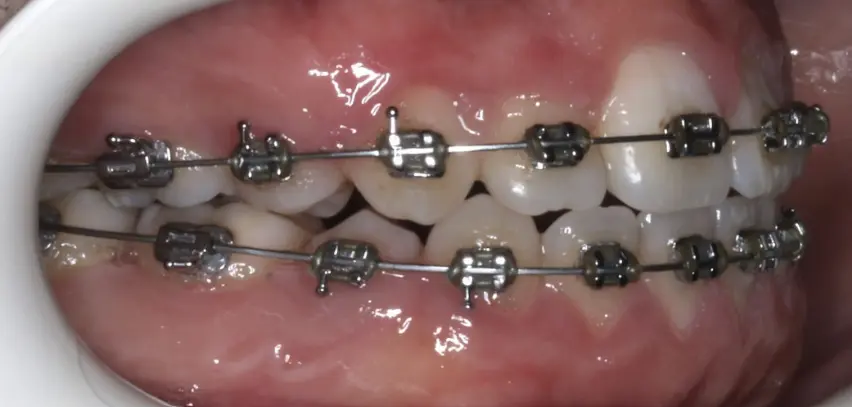 Después de la Ortodoncia