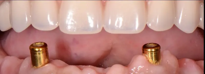 Antes de la Ortodoncia