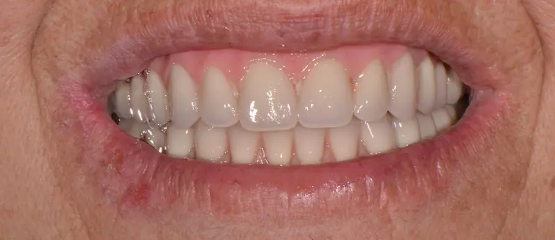 Después de la Ortodoncia